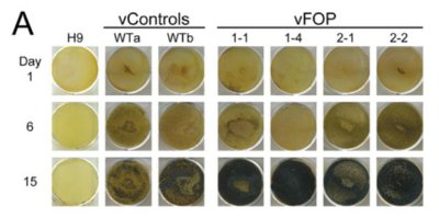 骨の難病をiPSで再現…京大、治療薬開発へ道