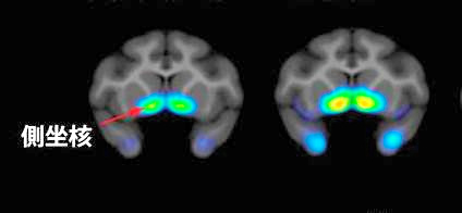 麻酔薬に使用のケタミン、抗うつ剤に有効-理研、動物で実証