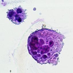 iPS血小板、臨床研究へ…難病患者に輸血