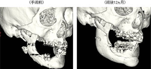 理研など、0.1mm単位で形状再現できる3Dプリンタ利用人工骨の薬事承認を申請
