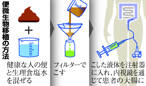 腸の難病、健康な人の便で治療? 慶大病院が臨床試験