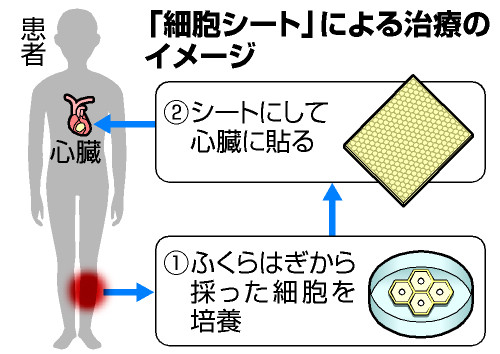 大阪大病院:心臓に自分の細胞移植 11歳女児退院へ