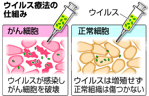 ウイルスで脳腫瘍治療 東大が臨床試験、遺伝子改変し患部注射