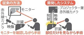 肝臓がん手術：切除部位照らす新技術 京大、プロジェクションマッピングを応用
