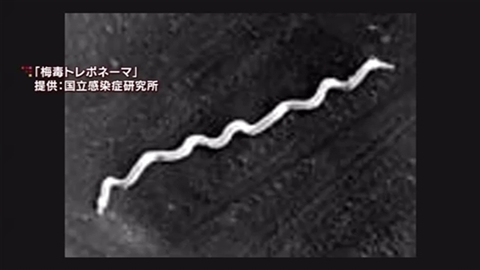 女性の梅毒感染急増＝昨年の２倍、啓発強化へ—厚労省