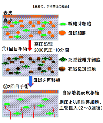 切除した"巨大なほくろ"自体を用いて皮膚を再建する治療法 - 関西医大など