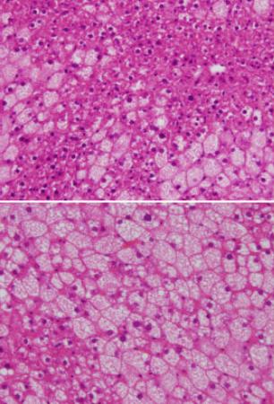 妊婦ダイエットで栄養不足 子供が脂肪肝のリスクも