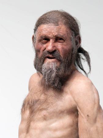 アイスマン、ピロリ菌に感染 ５千年前、胃炎に悩む？