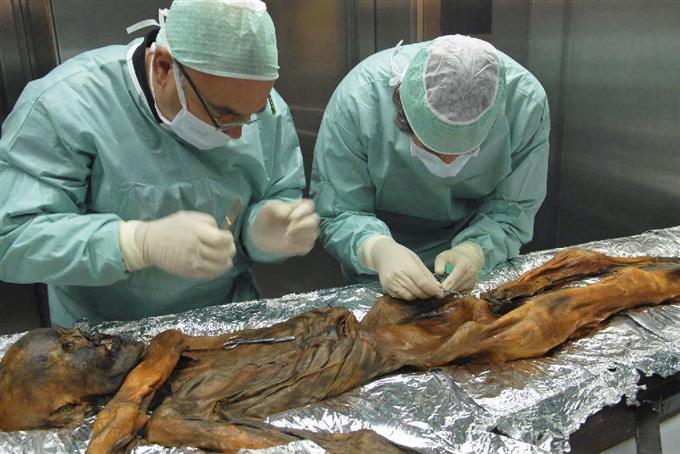 アイスマン、ピロリ菌感染 ５千年前、胃炎に悩む？