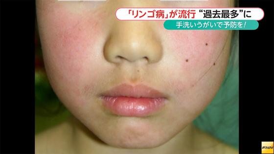 １０年で最多 国立感染研報告、昨年９．８万人