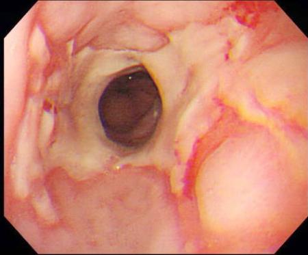 胃食道逆流症、禁煙で改善 大阪市立大発表