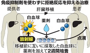 肝移植後の拒絶反応に光 北大など、薬使わない新治療