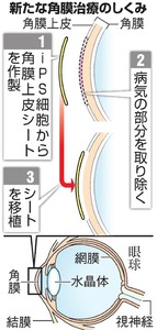 ｉＰＳから角膜細胞、阪大など作製成功 臨床研究へ前進