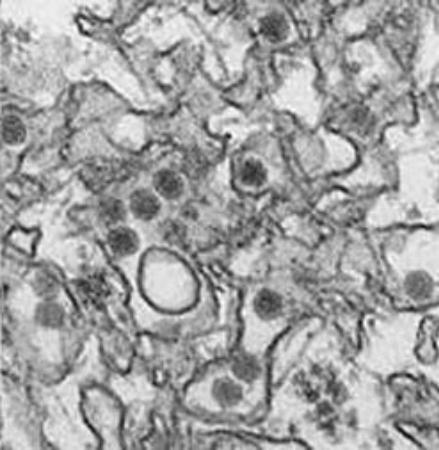 愛知の30代女性、ジカ熱に感染 ブラジルから帰国